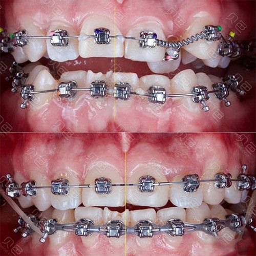 矫正牙齿要带多久弹簧-图3 矫正牙齿要带多久弹簧-图3