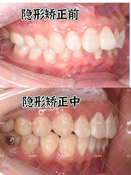 矫正牙齿哪个效果最好-图2
