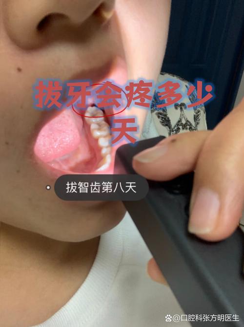 牙齿矫正拔牙后，多久该复查一次？-图3