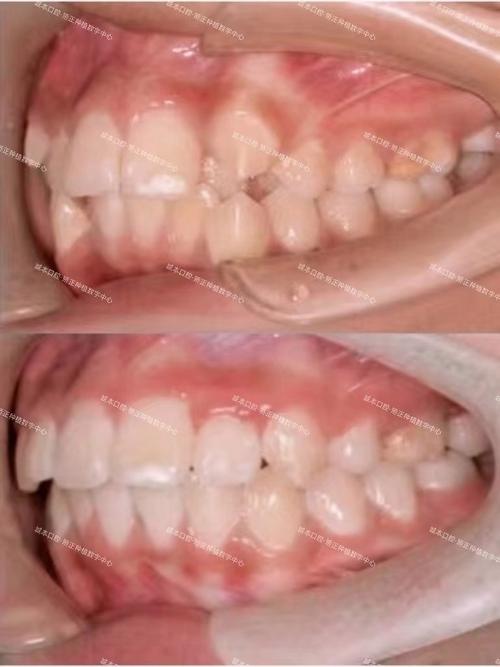 拥挤牙齿矫正失败案例频发,究竟哪些环节导致矫正失败?-图1 拥挤牙齿矫正失败案例频发,究竟哪些环节导致矫正失败?-图1
