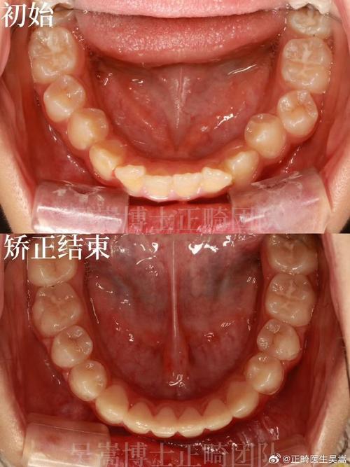 拥挤牙齿矫正失败案例频发,究竟哪些环节导致矫正失败?-图2 拥挤牙齿矫正失败案例频发,究竟哪些环节导致矫正失败?-图2