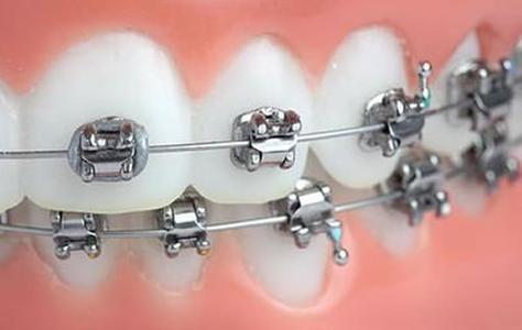 矫正牙齿的矫正器掉了-图1 矫正牙齿的矫正器掉了-图1