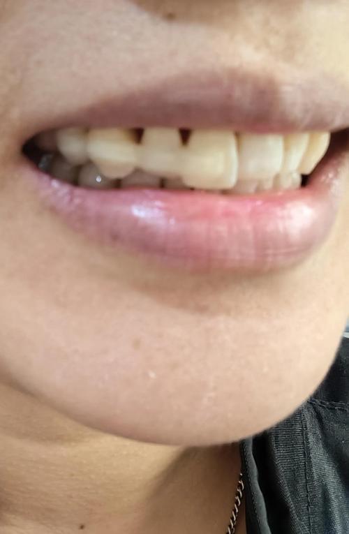 矫正牙齿过程中牙齿真的会松动吗？-图1