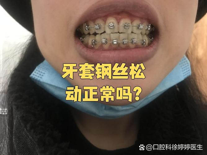 矫正牙齿过程中牙齿真的会松动吗？-图2