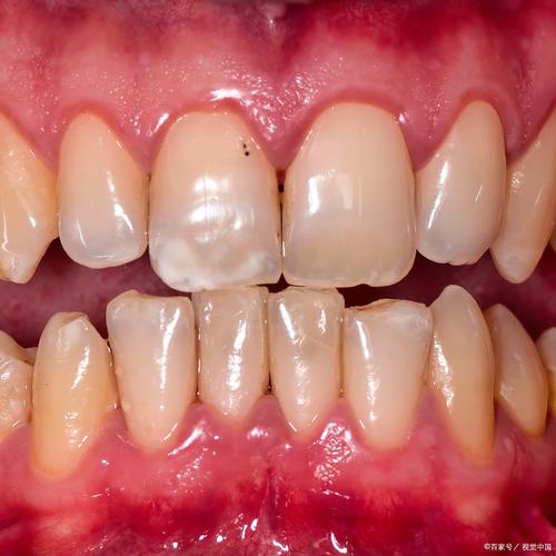 矫正牙齿过程中牙齿真的会松动吗？-图3