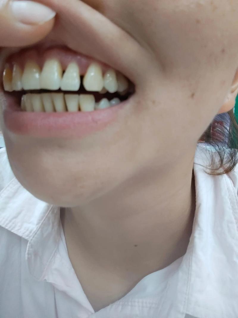 牙齿矫正后牙齿松动，是矫正过程中的正常反应吗？-图1