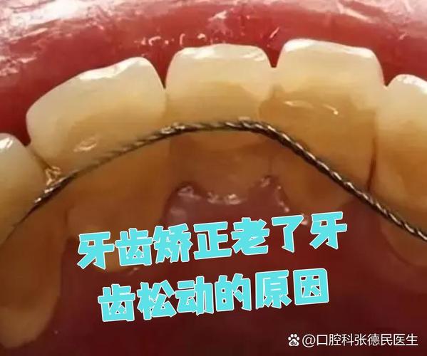 矫正牙齿老了牙齿松动-图1 矫正牙齿老了牙齿松动-图1
