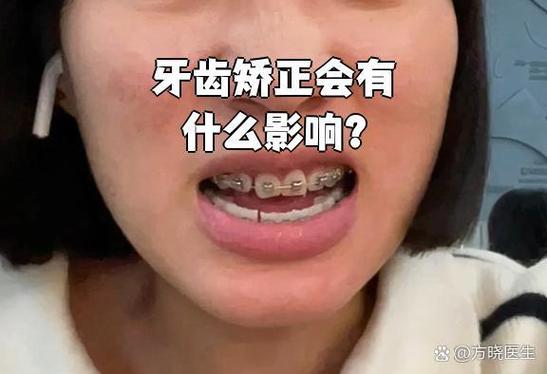 牙齿矫正感觉松动，是正常现象还是异常情况？-图2