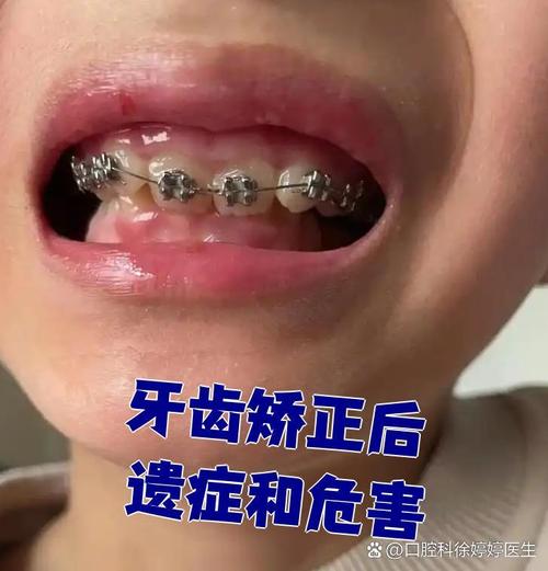 成年后牙齿矫正的后遗症，你了解多少？-图2