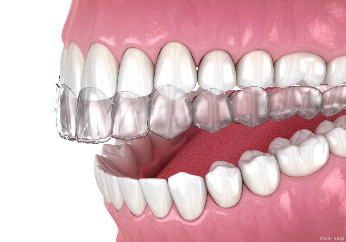 牙齿矫正一般多大年龄开始最合适？-图1