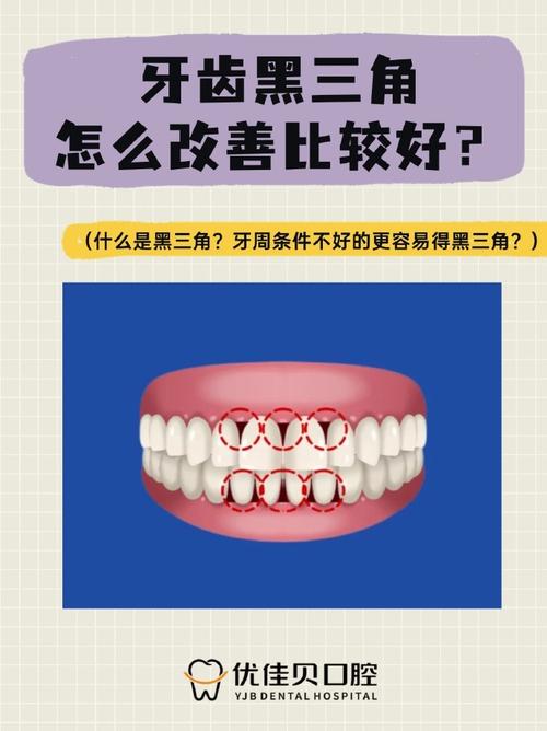 牙齿矫正后黑三角会自行变好吗?-图2 牙齿矫正后黑三角会自行变好吗?-图2