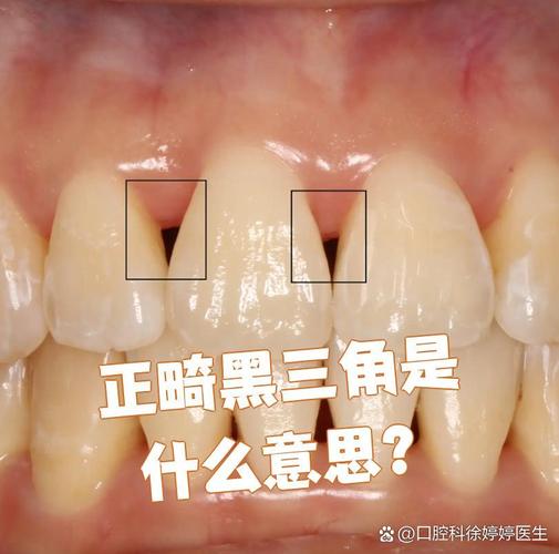 牙齿矫正后黑三角会自行变好吗?-图1 牙齿矫正后黑三角会自行变好吗?-图1