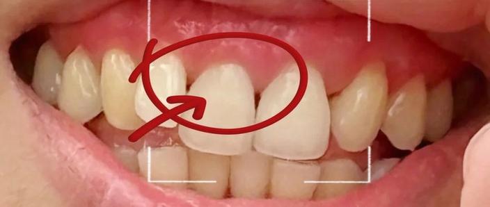 牙齿矫正后黑三角会自行变好吗?-图3 牙齿矫正后黑三角会自行变好吗?-图3