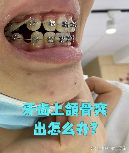 骨性前突牙齿矫正过程是怎样的?效果如何改善?-图2 骨性前突牙齿矫正过程是怎样的?效果如何改善?-图2