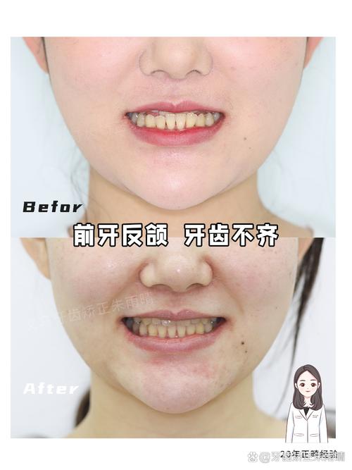 牙齿矫正可不可以通过不拔牙进行？关键看这些因素！-图2