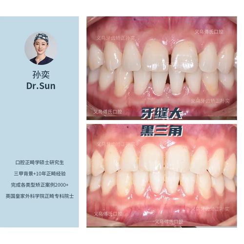 牙齿矫正后出现黑三角-图2
