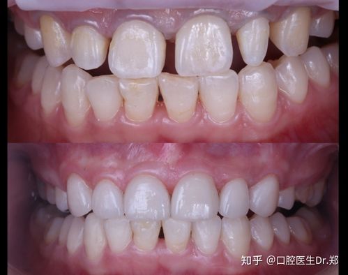 矫正牙齿后为何有黑三角?原因和解决方法-图2 矫正牙齿后为何有黑三角?原因和解决方法-图2