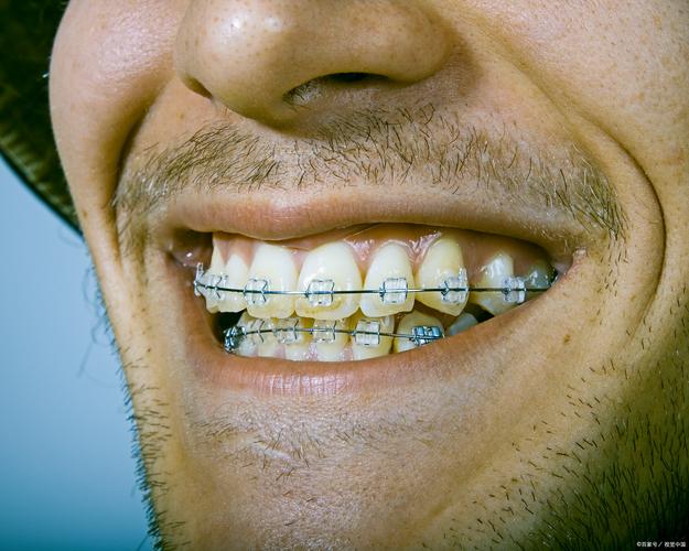 成年人矫正牙齿好不好？效果与风险如何？-图3
