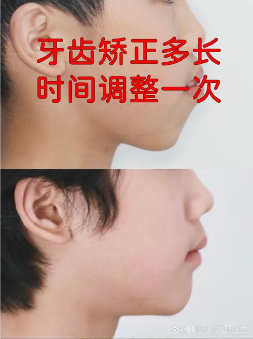 牙齿矫正到一半换城市，后续治疗怎么办？-图1