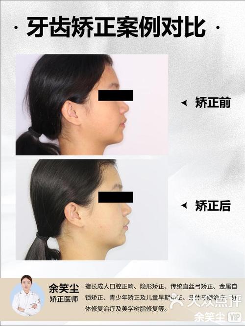 牙齿拥挤矫正真的有必要吗？不矫正会带来哪些健康和美观问题？-图2