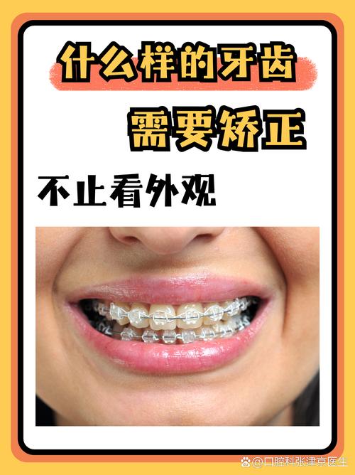 牙齿拥挤矫正真的有必要吗？不矫正会带来哪些健康和美观问题？-图3