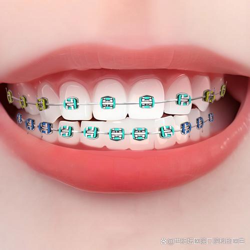 矫正牙齿用什么牙套好?不同牙套怎么选更合适?-图1 矫正牙齿用什么牙套好?不同牙套怎么选更合适?-图1
