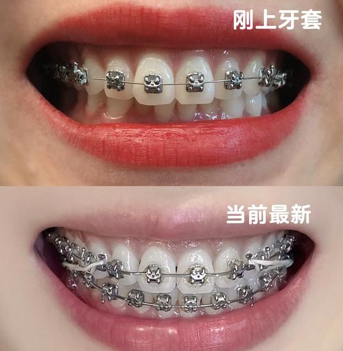 矫正牙齿的钢丝会断么-图1