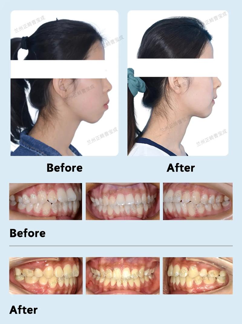 牙齿矫正对嘴型改变的影响有多大？效果显著吗？-图1
