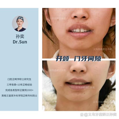 下牙齿缝隙大如何矫正？有哪些有效矫正方法？-图3