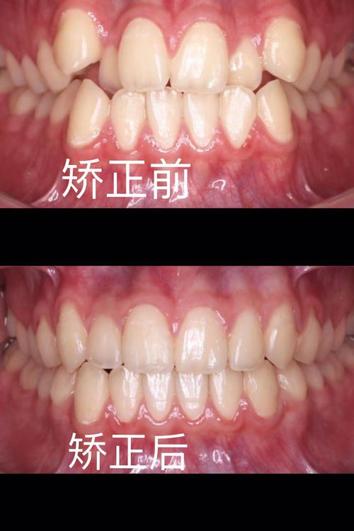牙齿往内凹矫正前后对比图效果差异有多大？-图1