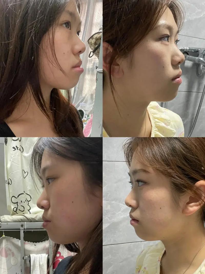 矫正牙齿后侧脸变好看？这背后有什么原因？-图1