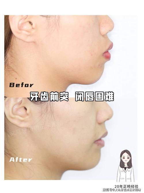 牙齿矫正能改善嘴突吗？-图2