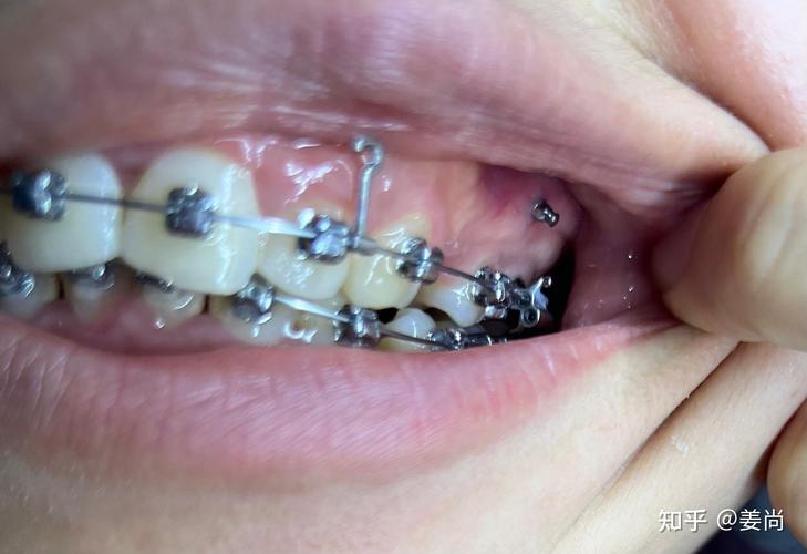 矫正牙齿后大牙烂了两颗该怎么办?-图2 矫正牙齿后大牙烂了两颗该怎么办?-图2