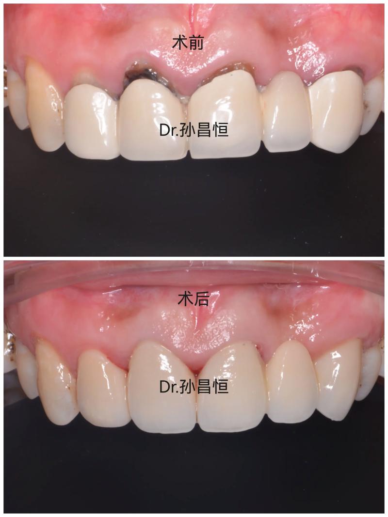 矫正牙齿后大牙烂了两颗该怎么办?-图3 矫正牙齿后大牙烂了两颗该怎么办?-图3