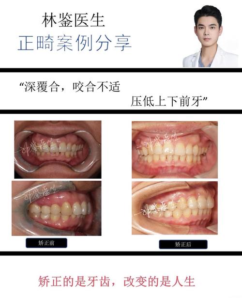矫正牙齿可以做手术吗？非手术矫正可行吗？-图1
