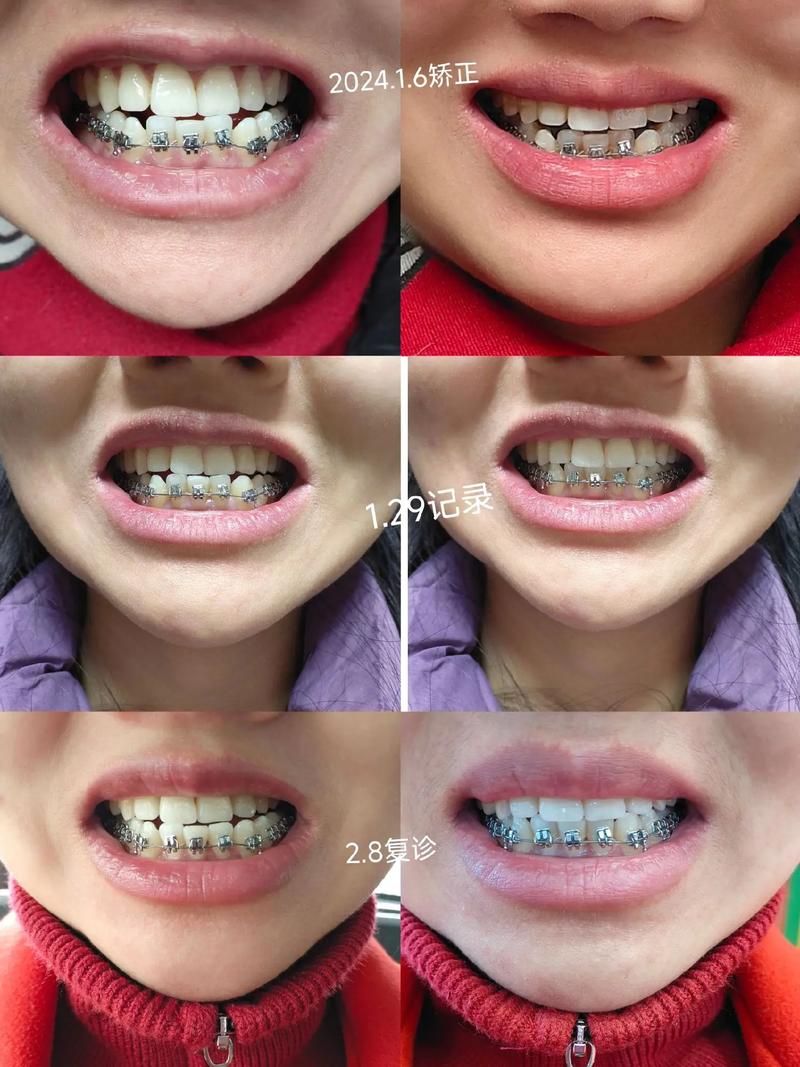 上海牙套矫正贵吗？费用大概多少？-图3