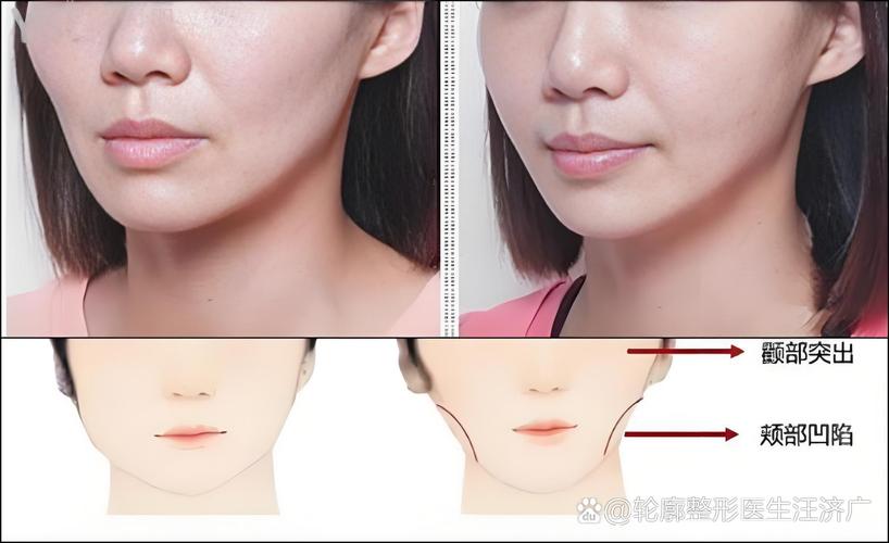 矫正牙齿颧骨会变高吗-图2