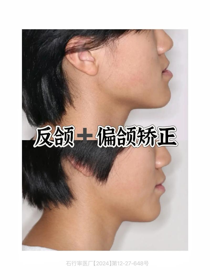 牙齿反颌矫正,脸型真的会变吗?-图1 牙齿反颌矫正,脸型真的会变吗?-图1