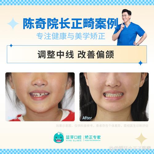 牙齿反颌矫正,脸型真的会变吗?-图2 牙齿反颌矫正,脸型真的会变吗?-图2