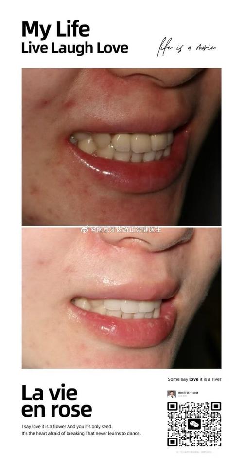 门牙烤瓷牙矫正牙齿吗-图3