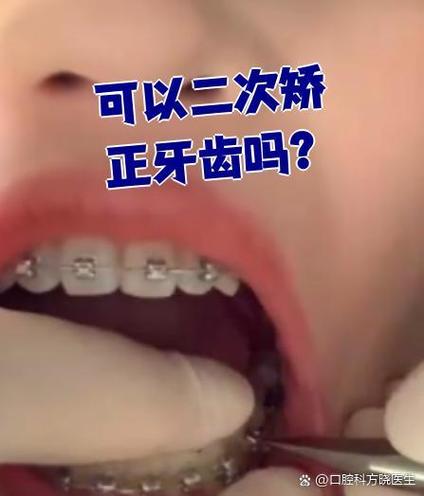 牙齿没换完能矫正吗？-图3