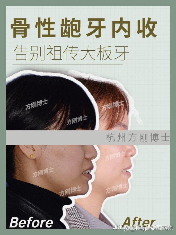 浙江口腔医院牙齿矫正-图1