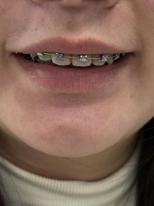 隐形矫正牙齿有后遗症-图3