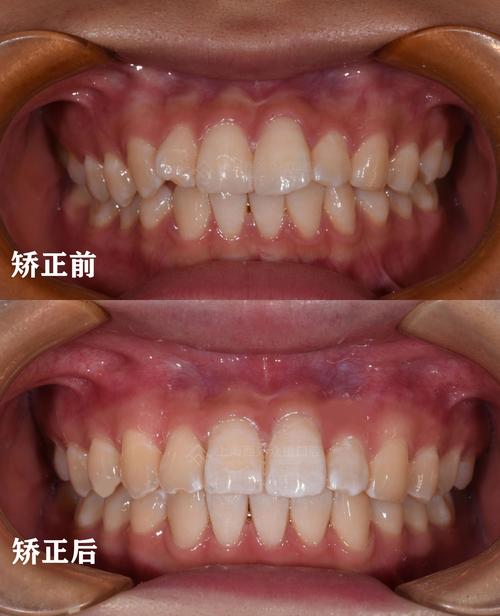 牙齿太稀矫正后，照片能看出牙齿变密吗？-图1