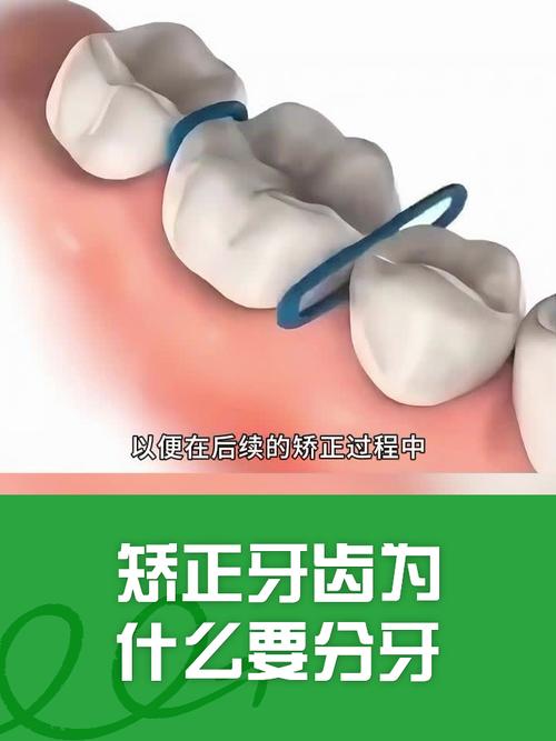牙齿矫正必须要分牙吗-图3