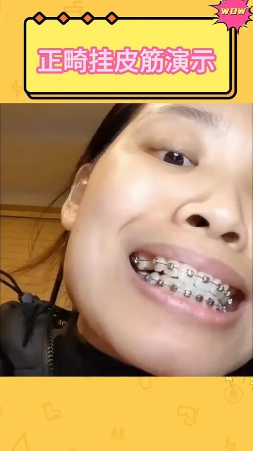 矫正橡皮筋误吃了会怎样？需要处理吗？-图3