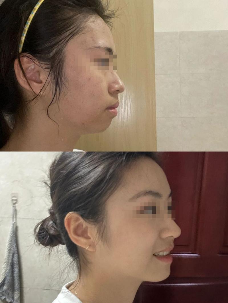 牙齿矫正后嘴巴真的会变小吗？-图2