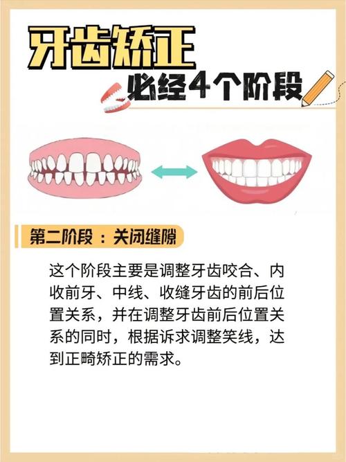 初中生矫正牙齿要多久?不同错颌畸形矫正时长有何差异?-图2 初中生矫正牙齿要多久?不同错颌畸形矫正时长有何差异?-图2