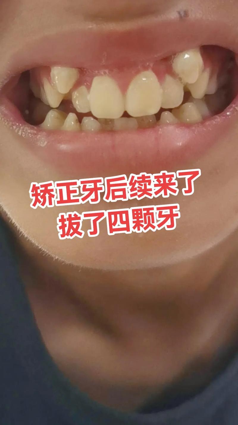 6号牙拔了能矫正牙齿-图1