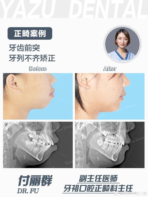 下排牙齿突出怎么矫正？有哪些有效方法？-图2